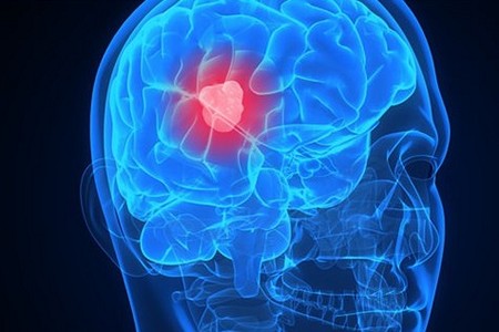 Beyinde kist tedavileri