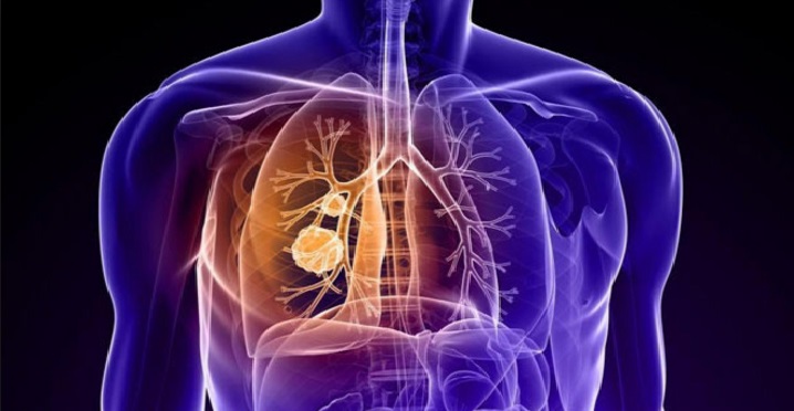 Sigaranın kardiyovaskuler sisteme olan zararları